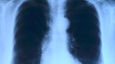 lastra ai polmoni